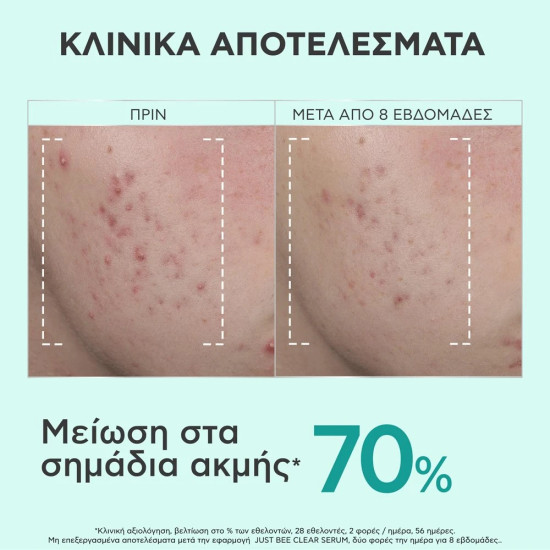 Apivita - Just Bee Clear Serum Azelaic Acid 10% Ορός με Αζελαϊκό Οξύ για Λείανση / Διόρθωση Ατελειών και Σημαδιών Ακμής - 30ml